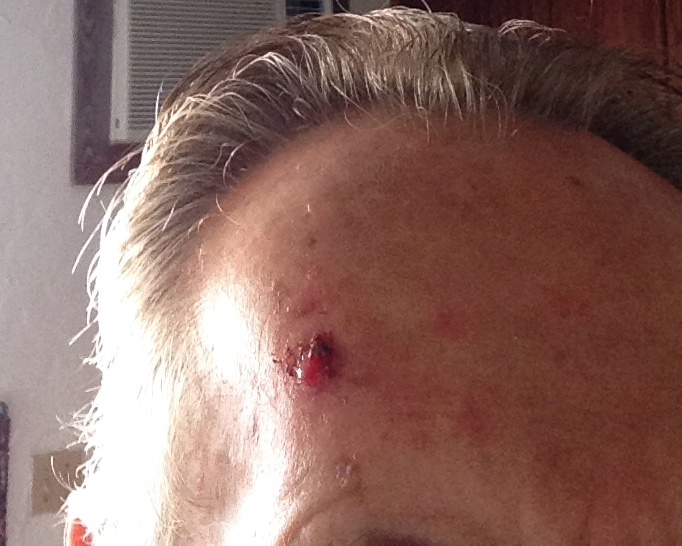 Photo of Basal Cell Carcinoma before using Perrin's Blend