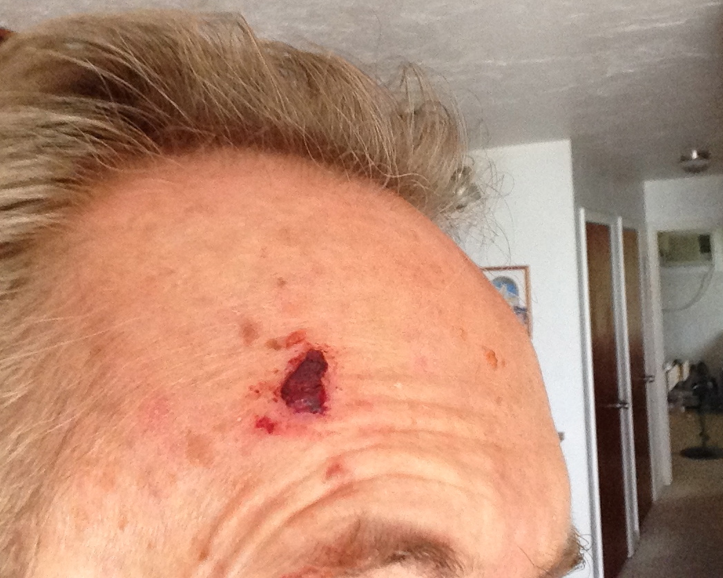Photo of basal cell carcinoma scabbed over