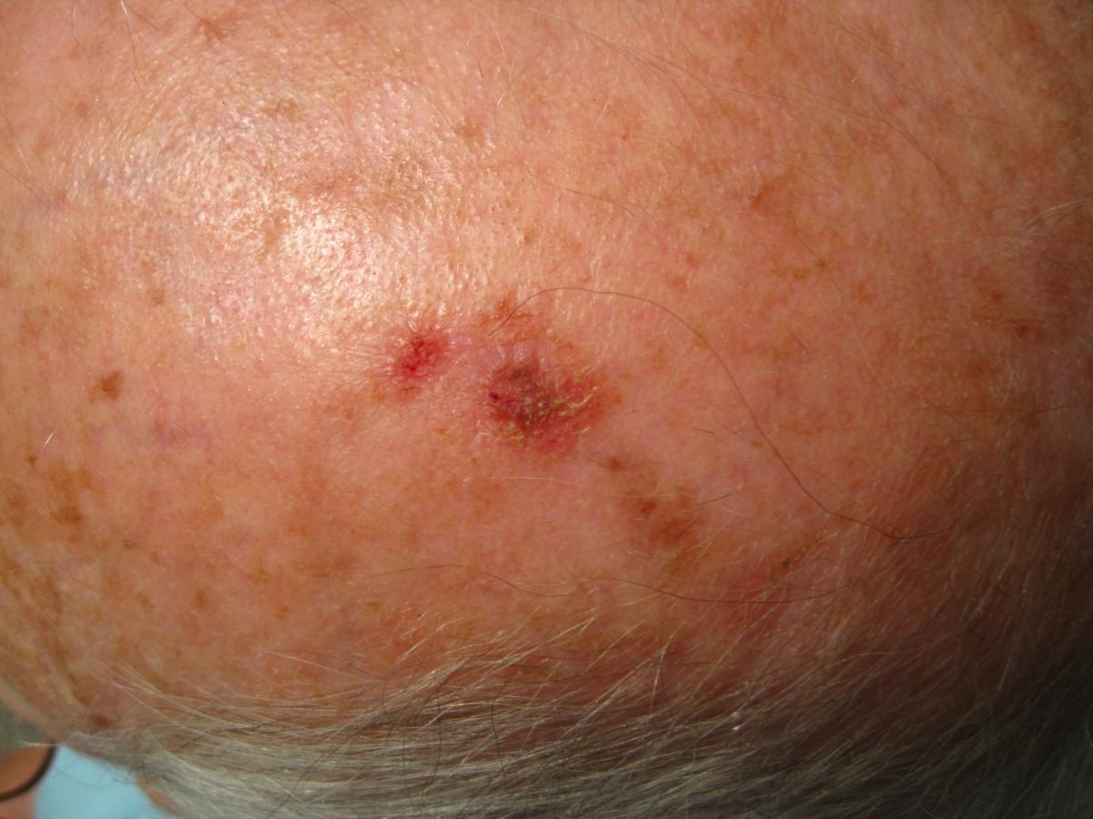 perrin's blend on skin lesion