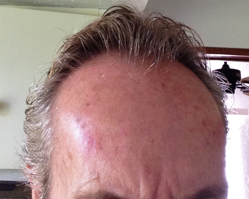 skin lesion on forehead completely healed