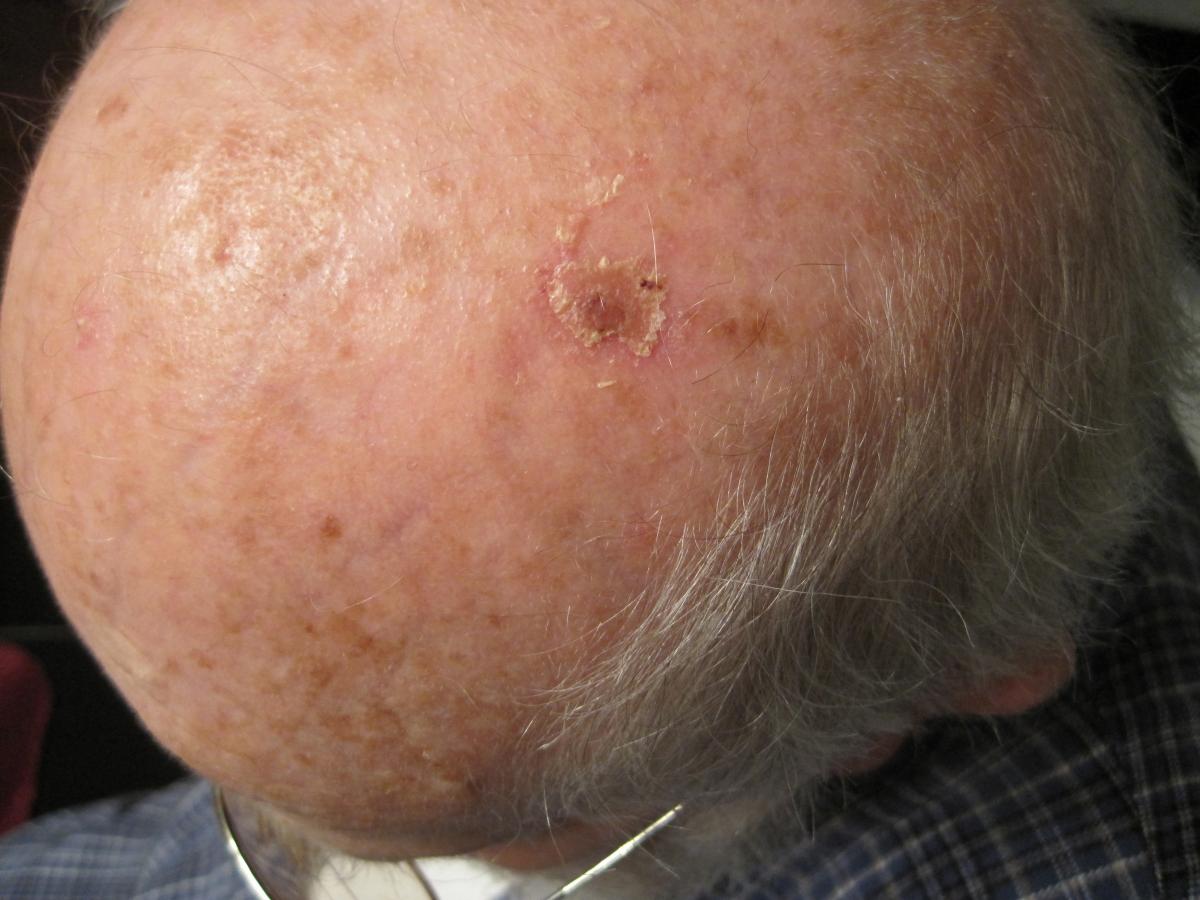 skin lesion on scalp