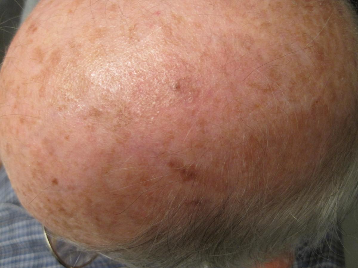 completely healed scalp