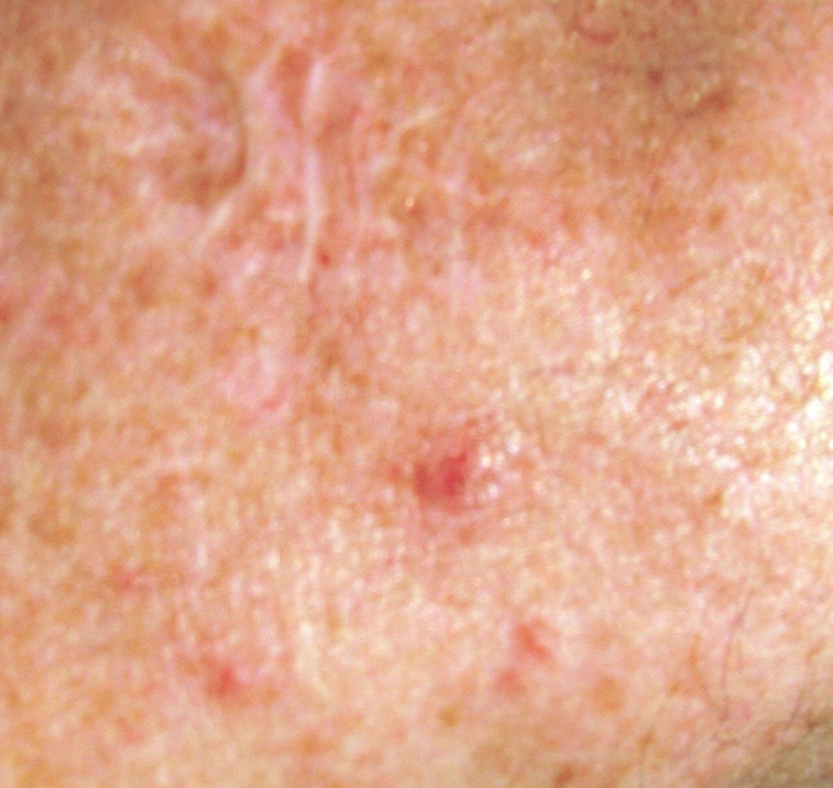basal cell carcinoma after treatment