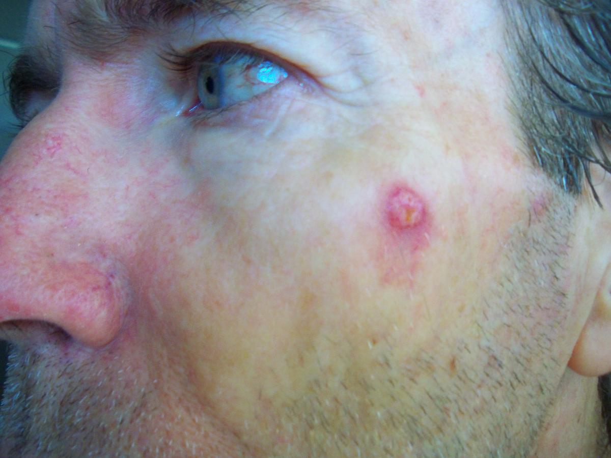 lesion removal carcinoma 1