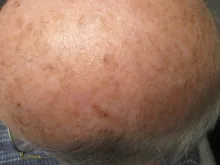 After Treatment with Perrin's Blend - Sixth photo - Taken three months after beginning treatment