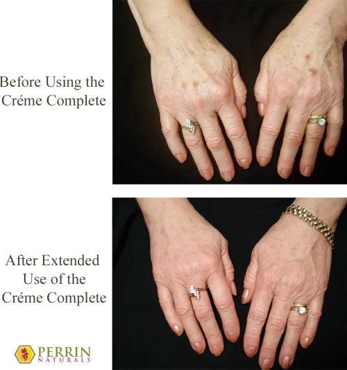 Creme Complete - Skin before and after Creme Complete - Skin before and after